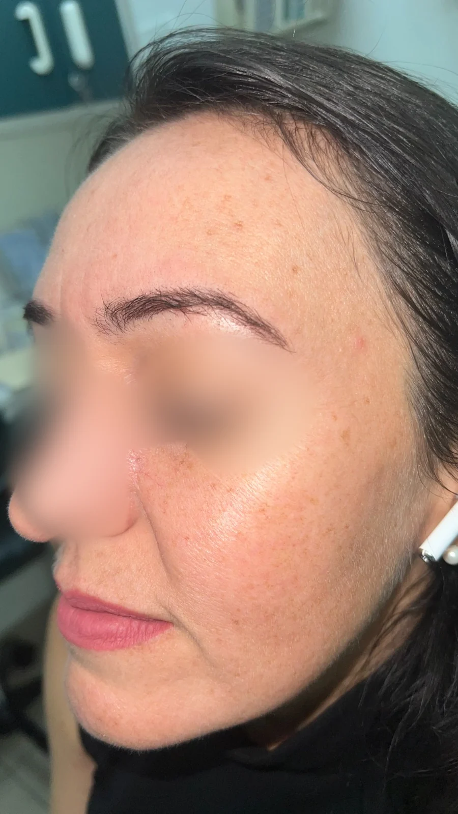 Carcinoma basocelular: Seguimiento