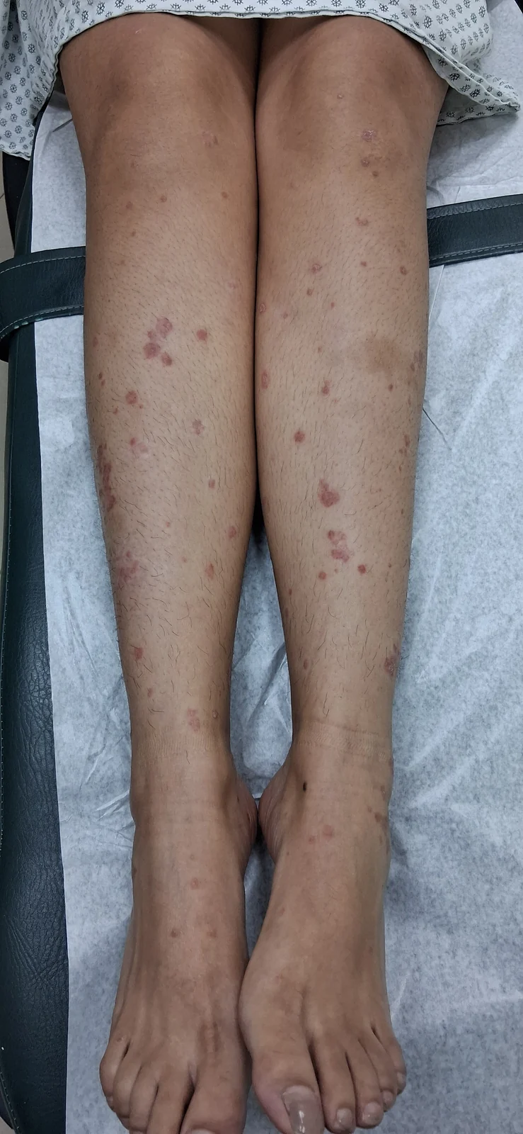 Psoriasis guttata: vista clínica