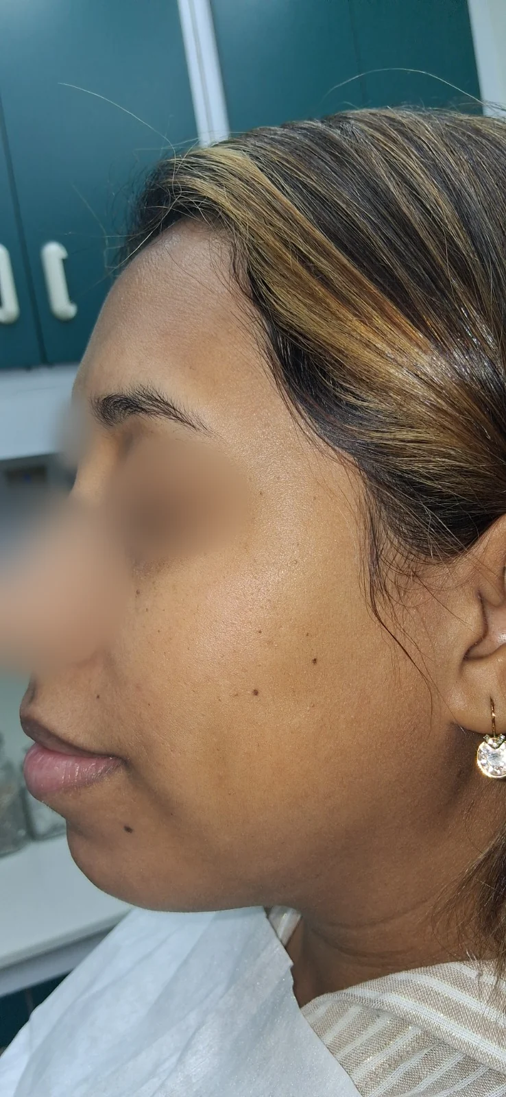 Queratosis seborreica: Antes