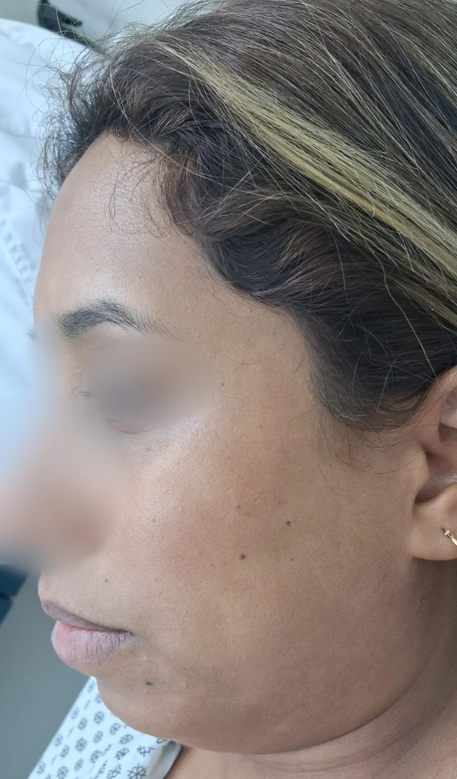 Queratosis seborreica: Seguimiento