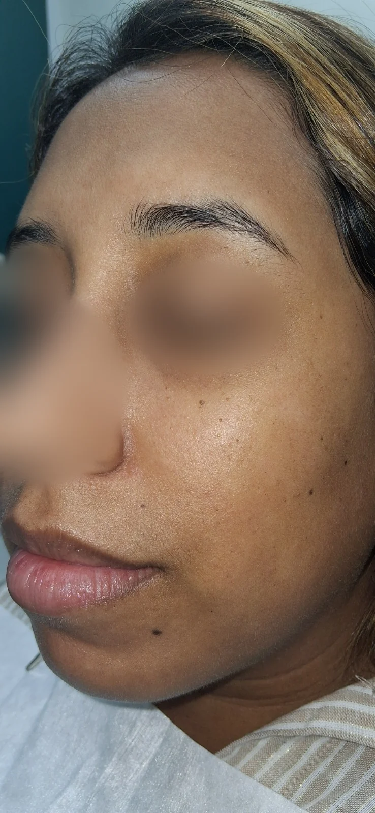 Queratosis seborreica: vista clínica