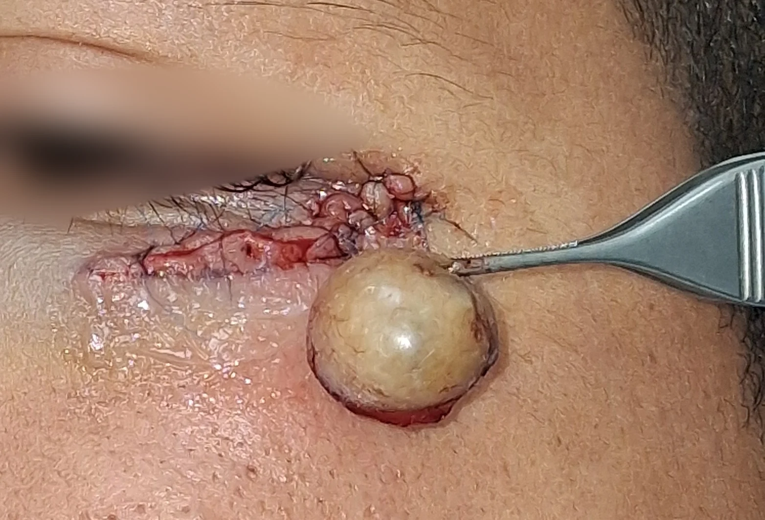 Quiste epidermoide: Durante el procedimiento
