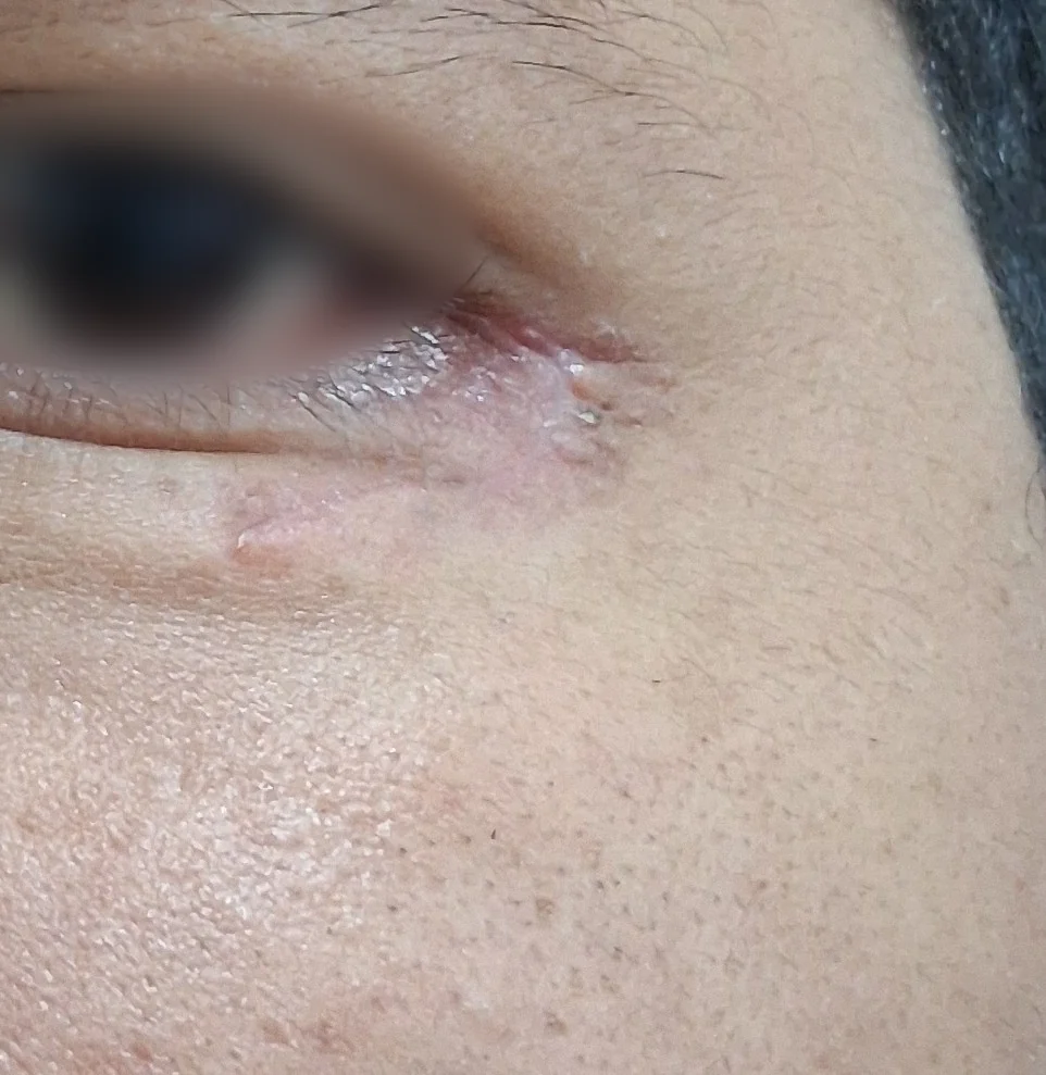 Quiste epidermoide: Seguimiento