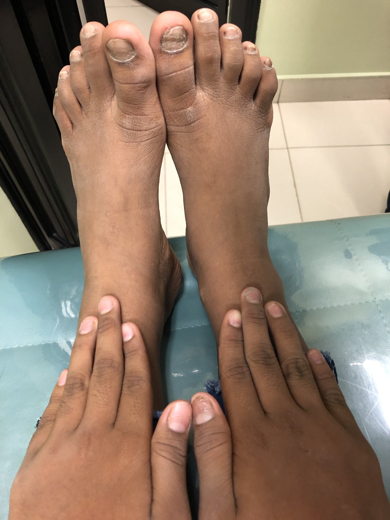 Dermatitis liquenoide vs psoriasis: imagen antes