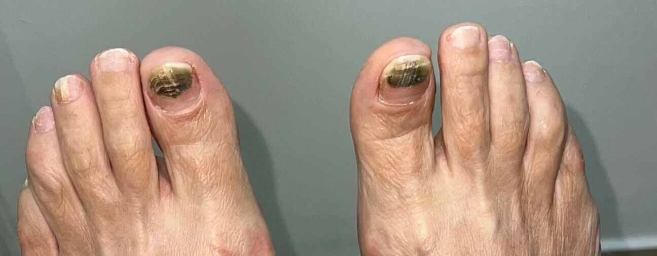 Pseudomonas subungueal: imagen antes