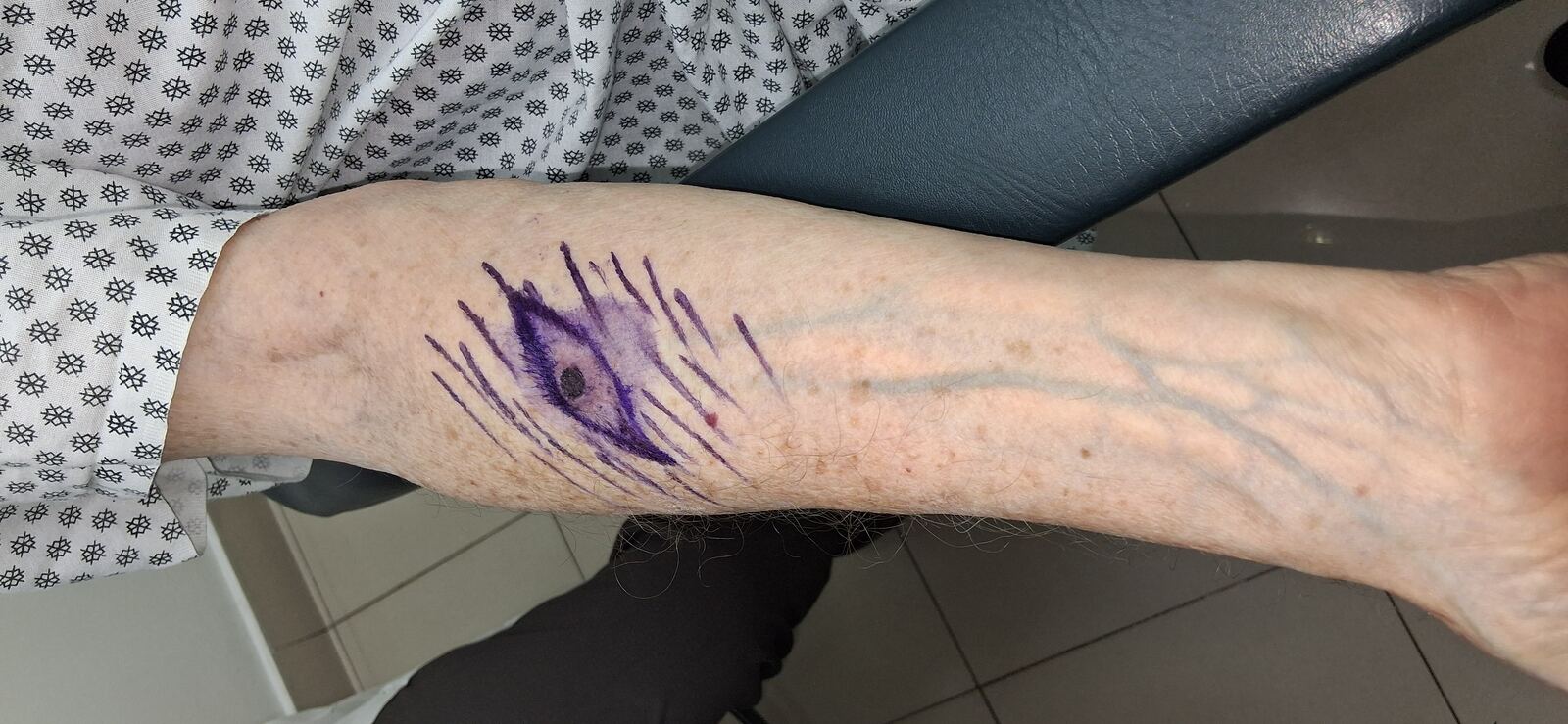 Queratoacantoma: imagen antes