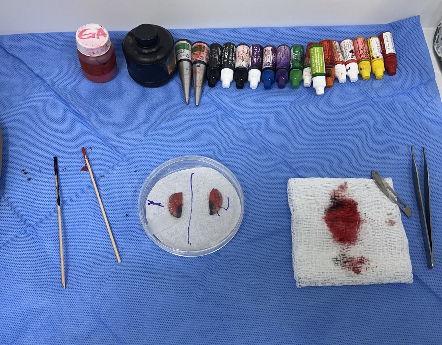 Cirugía de Mohs con control microscópico y reconstrucción
