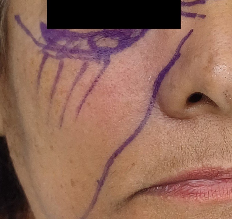 Cirugía de Mohs con control microscópico y reconstrucción