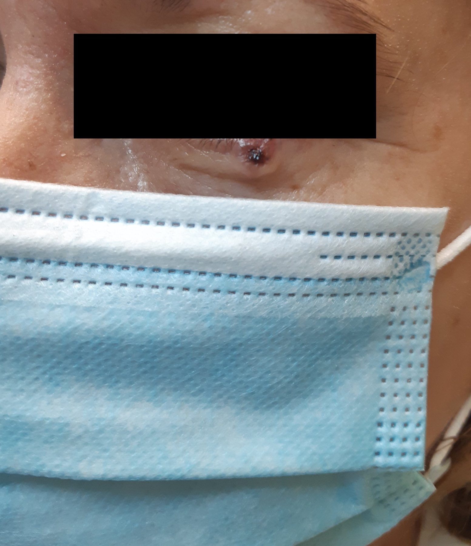 Cirugía de Mohs con control microscópico y reconstrucción