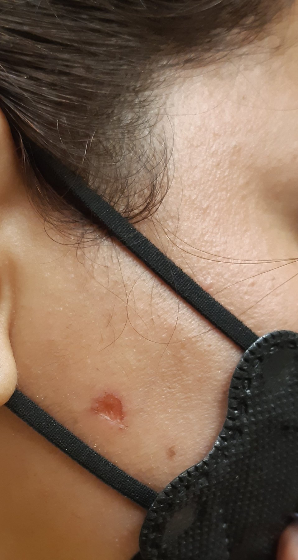 Cirugía de Mohs con control microscópico y reconstrucción
