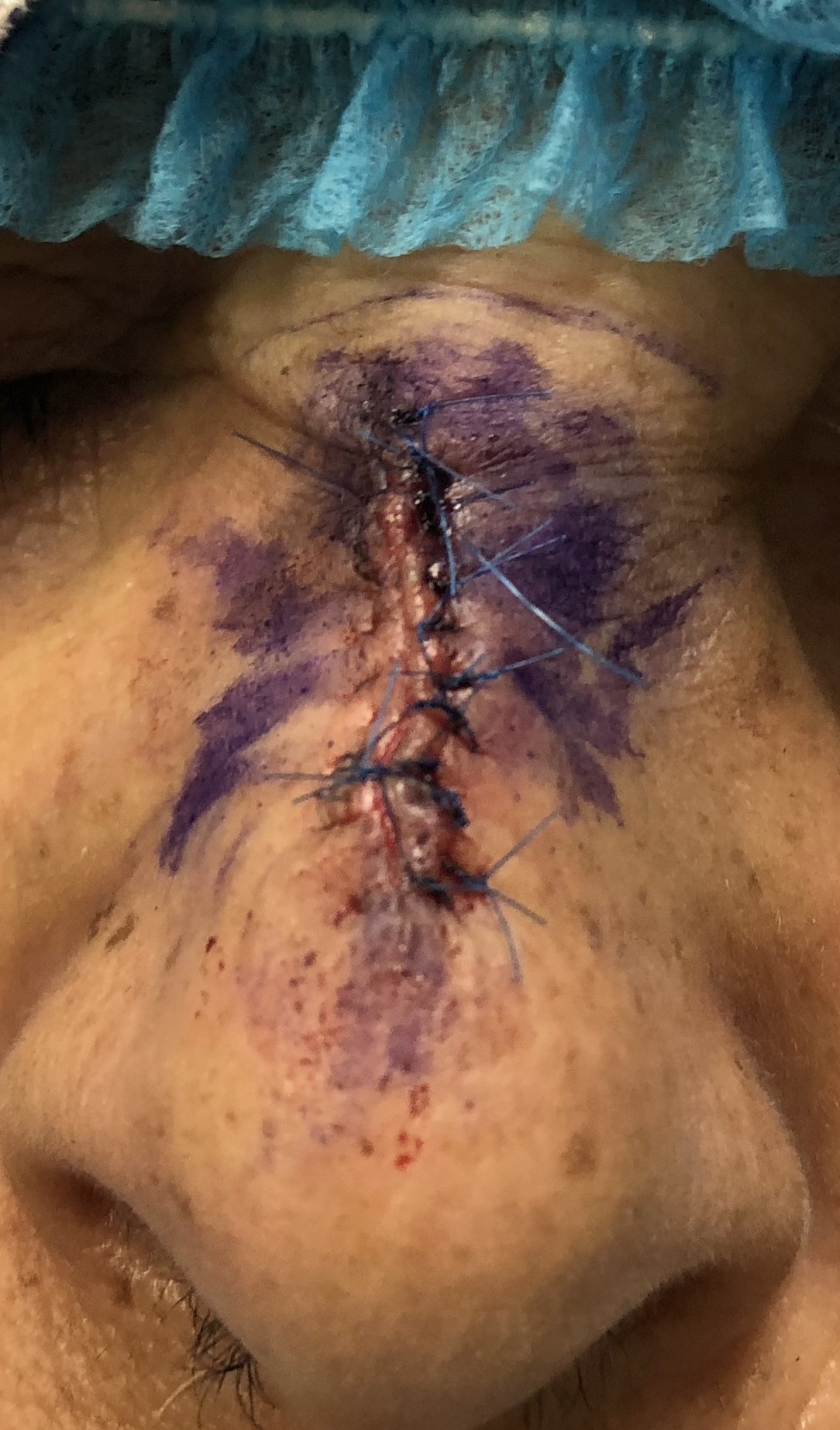 Antes: Cirugía de Mohs con control microscópico y reconstrucción