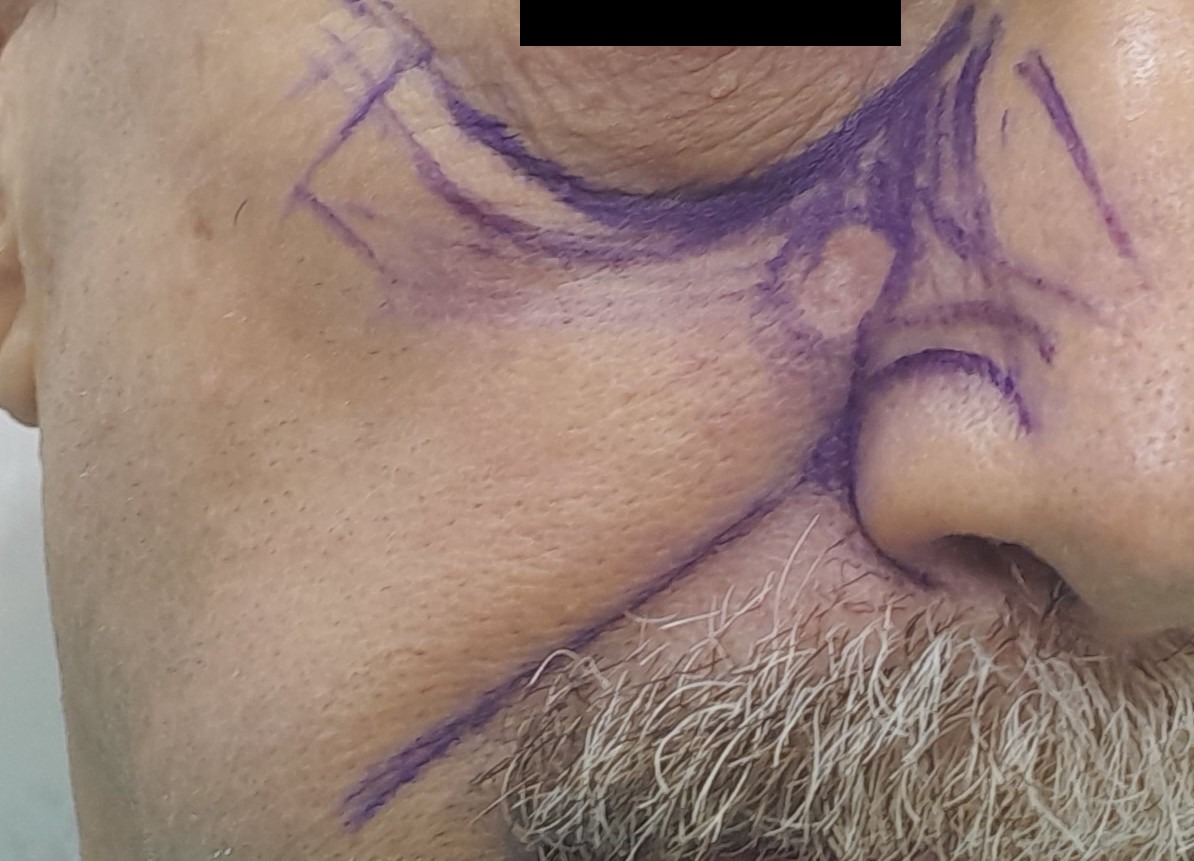 Cirugía de Mohs con control microscópico y reconstrucción