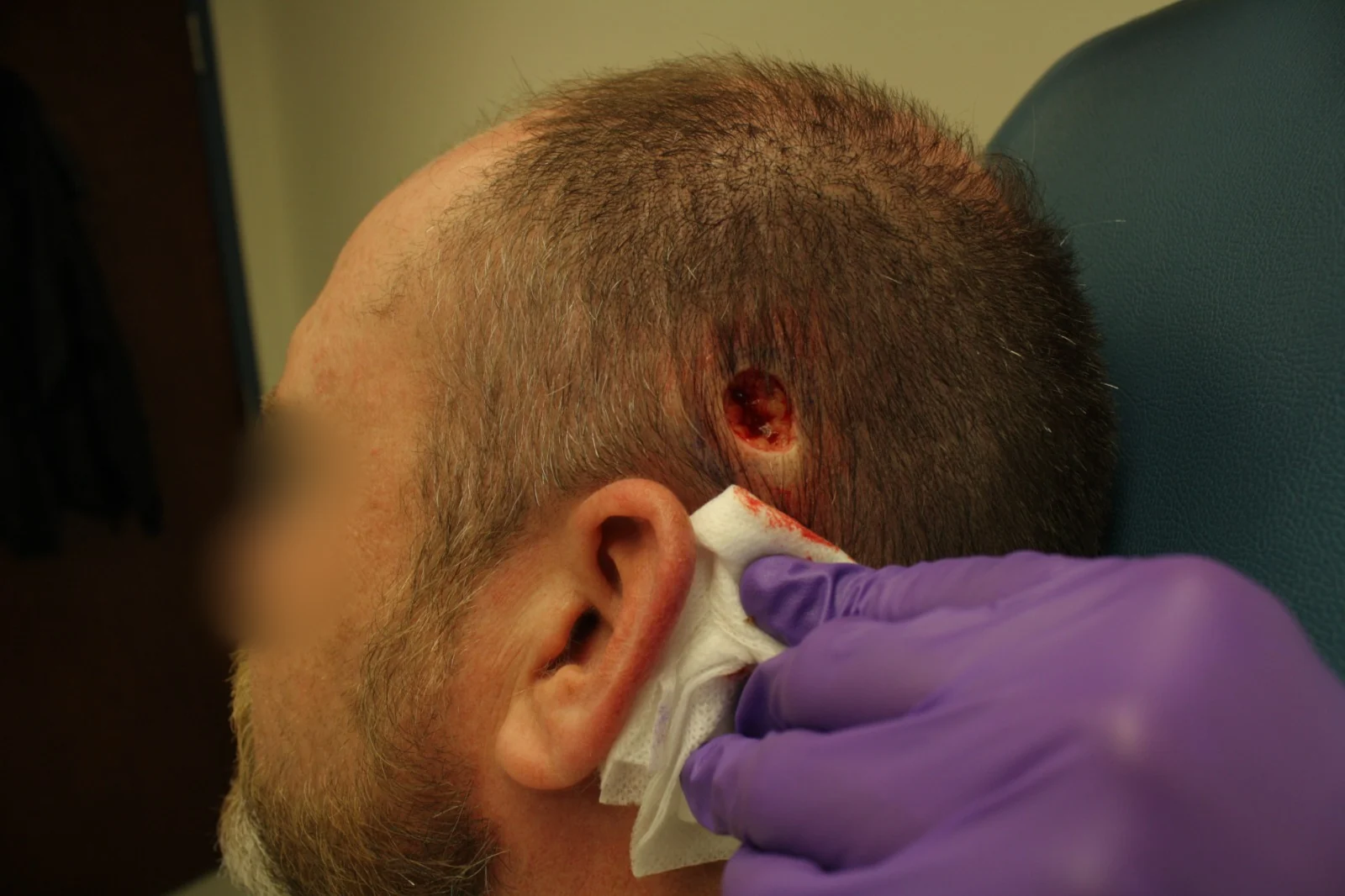 Cirugía de Mohs con control microscópico y reconstrucción: Durante el procedimiento