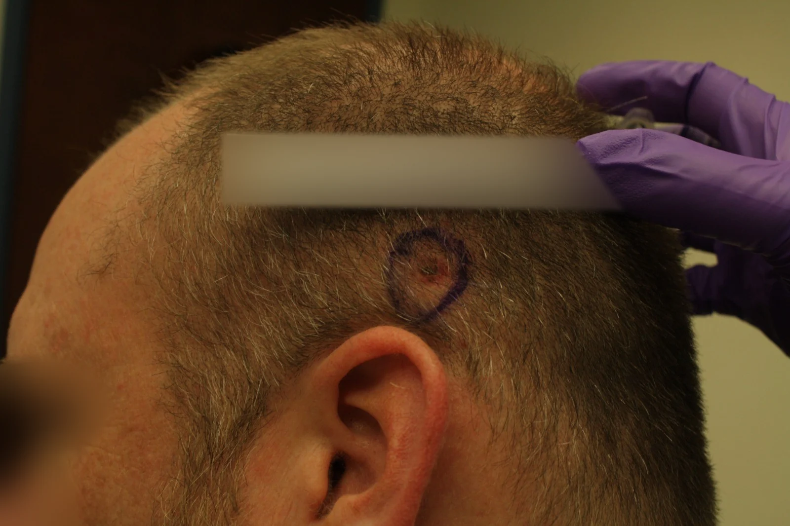 Cirugía de Mohs con control microscópico y reconstrucción