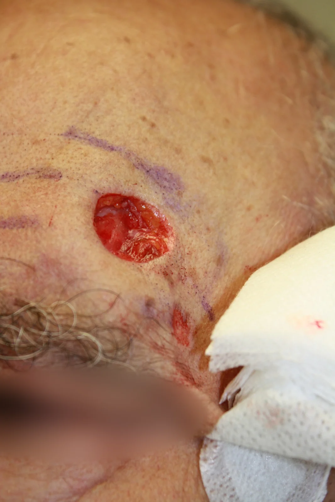 Cirugía de Mohs con control microscópico y reconstrucción: Durante el procedimiento