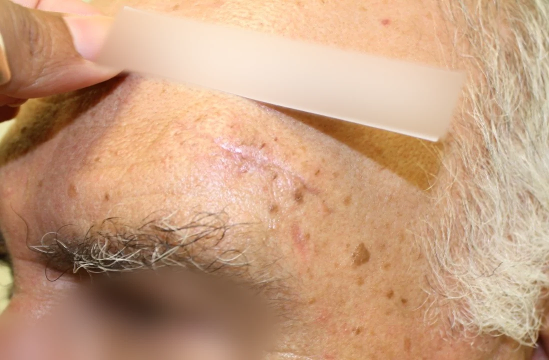 Cirugía de Mohs con control microscópico y reconstrucción: Seguimiento