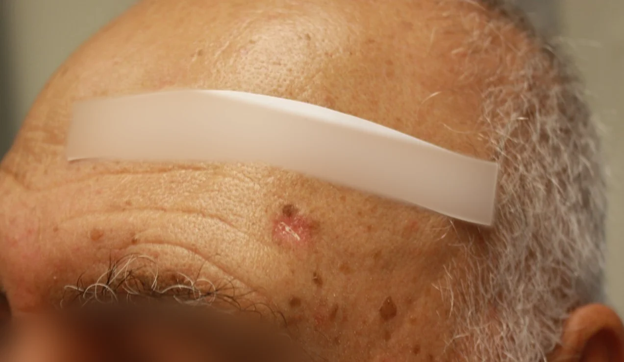 Cirugía de Mohs con control microscópico y reconstrucción