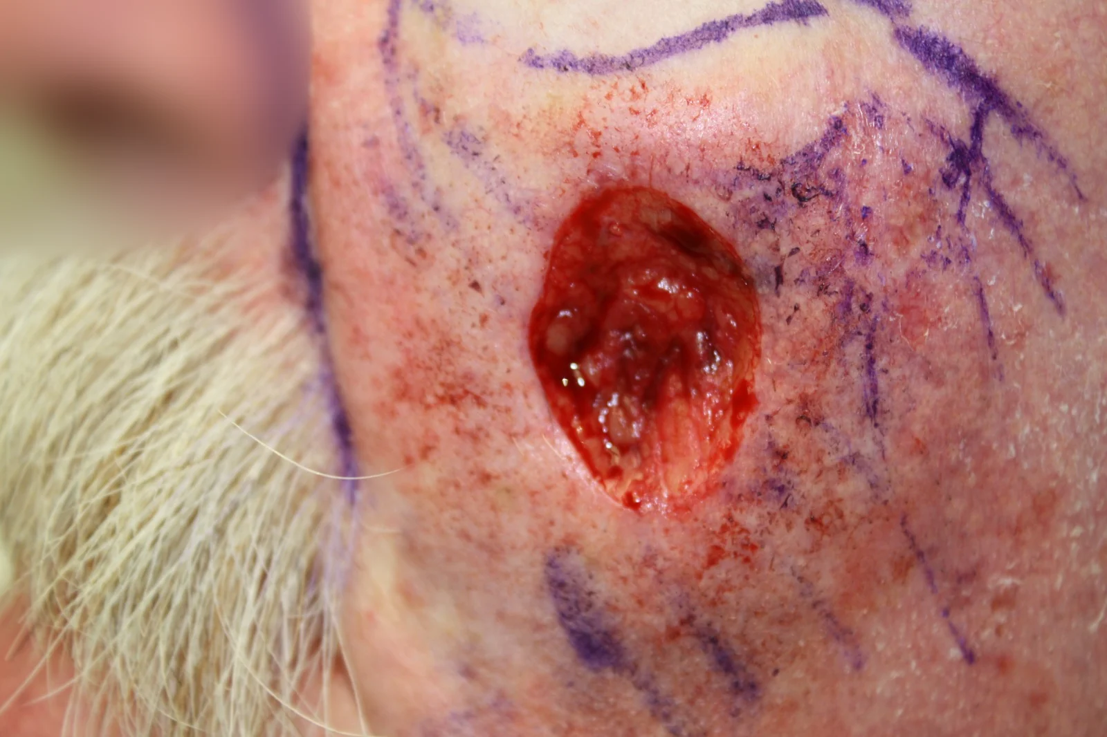 Cirugía de Mohs con control microscópico y reconstrucción: Durante el procedimiento