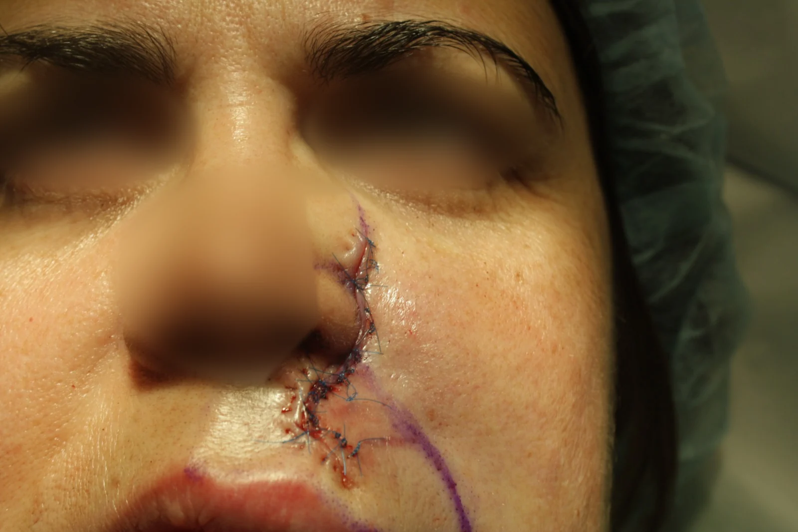 Cirugía de Mohs con control microscópico y reconstrucción: Reconstrucción